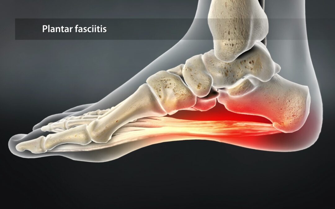 Plantar Fascitis: Causes and Treatment